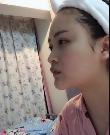 北京伊美爾美容愛康醫(yī)院醫(yī)生柳成做鼻綜合整形怎么樣？附案例效果圖