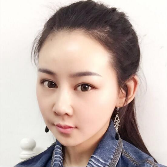 上海時光整形外科醫(yī)院醫(yī)生李靜林做假體隆鼻和反頜手術(shù)怎么樣？