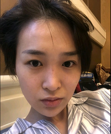 武漢米蘭醫(yī)療美容醫(yī)生柳再億做眼綜合+鼻綜合整形怎么樣？附真實案例對比圖