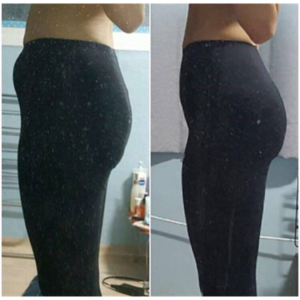 貴陽華美整形美容醫(yī)院醫(yī)生田永華做大腿吸脂效果怎么樣？附大腿吸脂案例前后對比圖