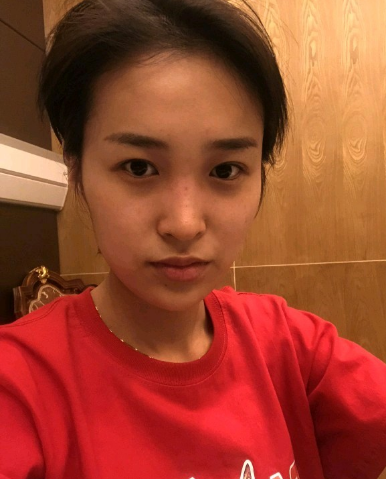 武漢米蘭醫(yī)療美容醫(yī)生柳再億做眼綜合+鼻綜合整形怎么樣？附真實案例對比圖