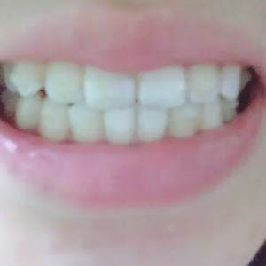 淄博口腔醫(yī)院醫(yī)生牟象鑫做超聲波洗牙怎么樣？附案例效果對(duì)比圖