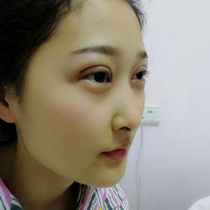 周口垣夢醫(yī)療整形醫(yī)生王濤做切開雙眼皮怎么樣？附切開雙眼皮案例效果對比圖