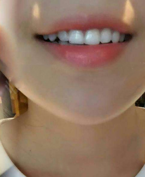 淄博口腔醫(yī)院醫(yī)生牟象鑫做超聲波洗牙怎么樣？附案例效果對(duì)比圖