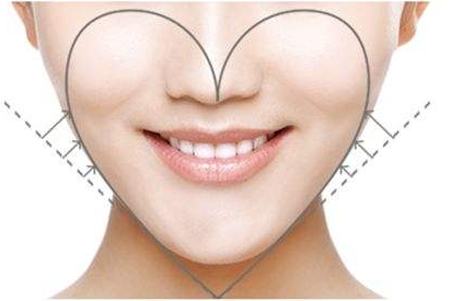 潮州博蘭雅整形下頜角整形