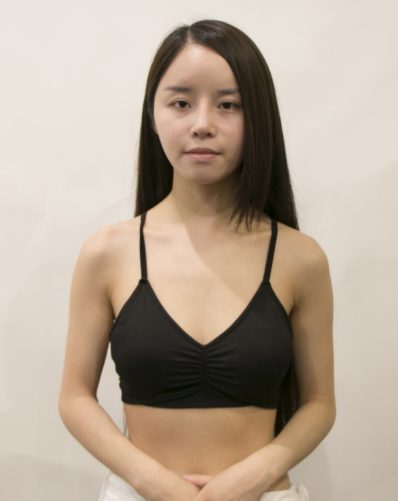 吉林現(xiàn)代整形美容醫(yī)院做假體隆胸效果怎么樣？附醫(yī)院案例效果對(duì)比圖