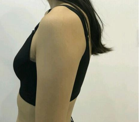 武漢伽美醫(yī)療美容醫(yī)院醫(yī)生朱富初做自體脂肪隆胸怎么樣？看案例