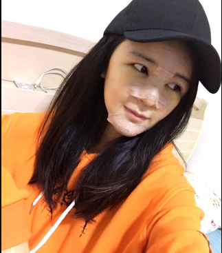 上海時(shí)光整形外科醫(yī)院醫(yī)生何晉龍做假體隆胸怎么樣？附案例效果對比圖