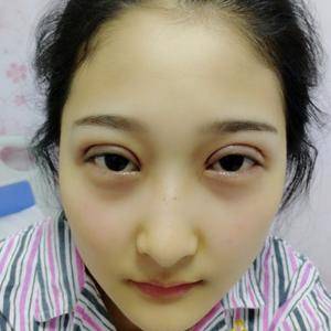 周口垣夢醫(yī)療整形醫(yī)生王濤做切開雙眼皮怎么樣？附切開雙眼皮案例效果對比圖