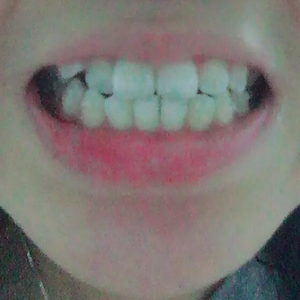 淄博口腔醫(yī)院醫(yī)生牟象鑫做超聲波洗牙怎么樣？附案例效果對(duì)比圖