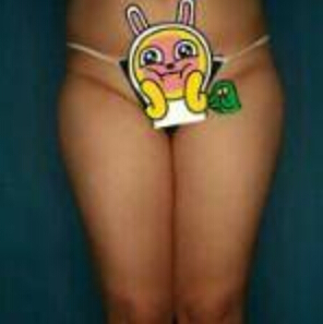 貴陽華美整形美容醫(yī)院醫(yī)生田永華做大腿吸脂效果怎么樣？附大腿吸脂案例前后對比圖