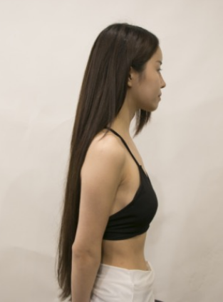 吉林現(xiàn)代整形美容醫(yī)院做假體隆胸效果怎么樣？附醫(yī)院案例效果對(duì)比圖