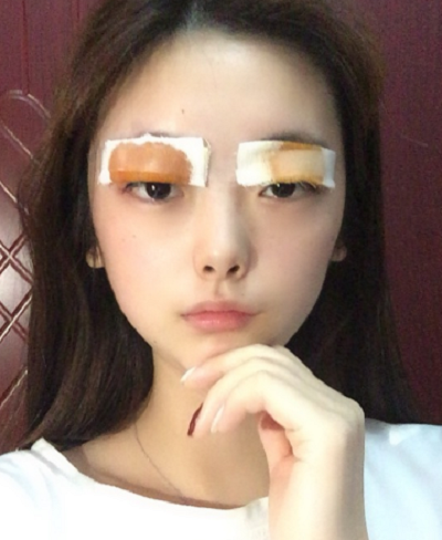 合肥韓美整形醫(yī)院做雙眼皮效果怎么樣?附石顯武醫(yī)生案例 合肥韓美整形醫(yī)院做雙眼皮效果怎么樣?附石顯武醫(yī)生案例