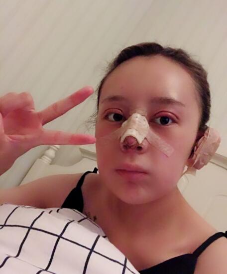 上海時光整形外科醫(yī)院雙眼皮+隆鼻+下頜角案例