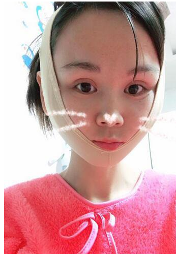 上海時(shí)光整形醫(yī)生何晉龍做下頜角磨骨術(shù)前術(shù)后案例效果對(duì)比圖