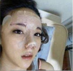 上海時(shí)光整形醫(yī)生何晉龍做假體隆鼻效果怎么樣？附案例效果對(duì)比圖