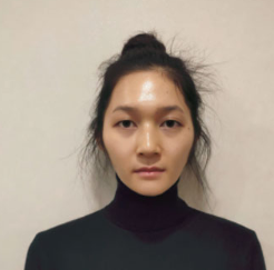 上海時(shí)光整形醫(yī)院做面部玻尿酸注射效果怎么樣？