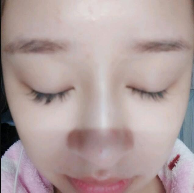 上海時(shí)光整形做玻尿酸注射隆鼻效果怎么樣？附陳文慧醫(yī)生真實(shí)案例對(duì)比圖