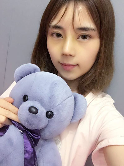 合肥韓美整形醫(yī)院做隆鼻手術(shù)效果怎么樣?附金壽信醫(yī)生案例 合肥韓美整形醫(yī)院做隆鼻手術(shù)效果怎么樣?附金壽信醫(yī)生案例