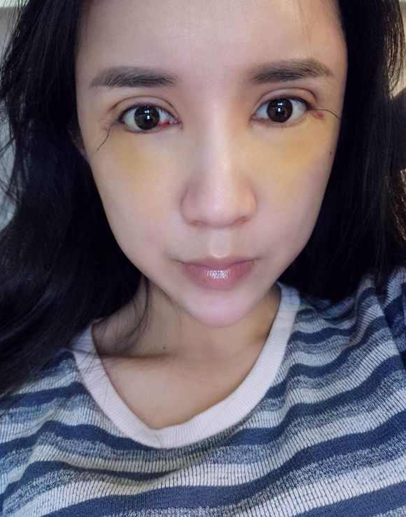 上海時(shí)光整形醫(yī)院張晶醫(yī)生做開眼角怎么樣？附真實(shí)效果圖