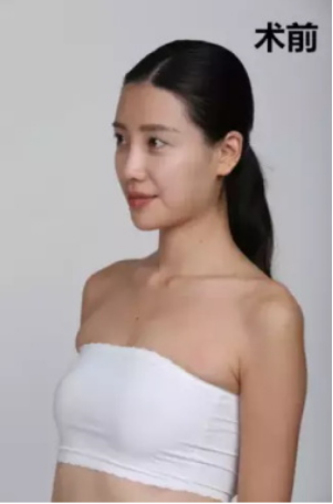 上海時(shí)光整形醫(yī)院何晉龍醫(yī)生做假體隆胸怎么樣？附案例對(duì)比圖