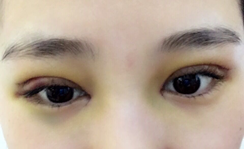 蚌埠韓美美萊整形醫(yī)生鄭捷做開眼角怎么樣？附案例效果圖