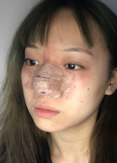 蚌埠韓美美萊整形做手術(shù)縮鼻頭效果怎么樣？附周娜醫(yī)生縮鼻頭案例效果圖