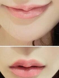 巴中時(shí)光醫(yī)學(xué)美容門診部做玻尿酸豐唇效果怎么樣？附李紅強(qiáng)豐唇案例