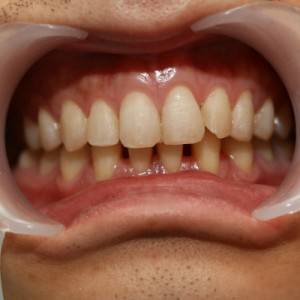 鞍山時代口腔門診部做瓷貼面案例效果圖