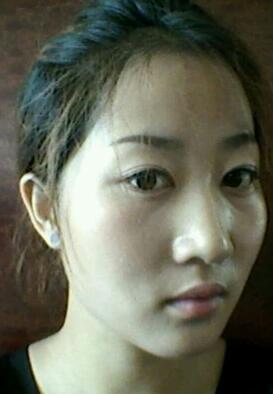 鞍山菲之都整形醫(yī)生李宗亮做字體脂肪豐太陽穴效果怎么樣？附案例效果對比圖