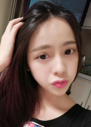 鞍山王景醫(yī)療美容外科診所做自體脂肪豐蘋(píng)果肌效果怎么樣？附張婉鸝案例效果圖