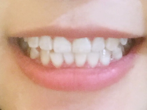 安慶渡江口腔醫(yī)院張良斌醫(yī)生做超聲波洗牙效果怎么樣？附洗牙案例效果圖