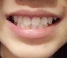 鞍山時代口腔門診部劉昕醫(yī)生做美容冠效果怎么樣？一起來看看吧