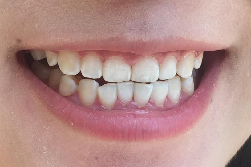 安慶渡江口腔醫(yī)院張良斌醫(yī)生做超聲波洗牙效果怎么樣？附洗牙案例效果圖