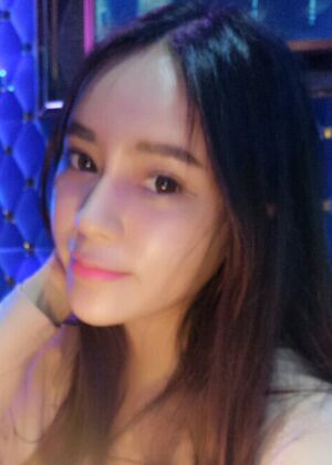 鞍山王景醫(yī)療美容外科診所做自體脂肪豐蘋(píng)果肌效果怎么樣？附張婉鸝案例效果圖