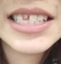 鞍山時代口腔門診部劉昕醫(yī)生做美容冠效果怎么樣？一起來看看吧