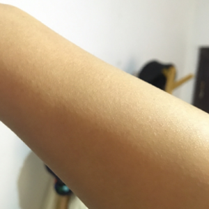 蚌埠市第三人民醫(yī)院燒傷整形科李勇醫(yī)生做手臂激光脫毛案例效果圖