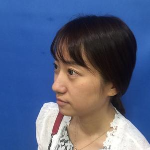 蚌埠韓美美萊整形做玻尿酸面部除皺效果怎么樣？附陳澤醫(yī)生案例效果圖