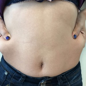 蚌埠韓美美萊整形醫(yī)生張濤做水動力吸脂怎么樣？附吸脂案例效果圖