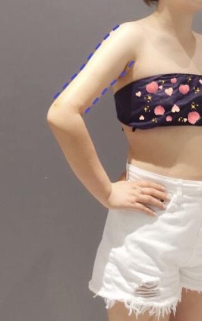 蚌埠市第三人民醫(yī)院燒傷整形科楊蔚做手臂吸脂效果對比圖 蚌埠市第三人民醫(yī)院燒傷整形科楊蔚做手臂吸脂效果對比圖