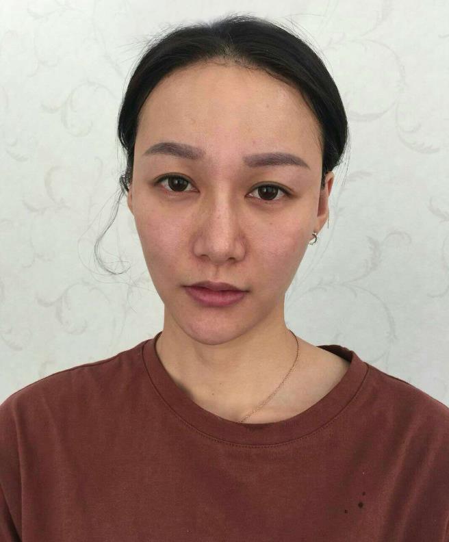 鞍山王景醫(yī)療美容外科診所做光子嫩膚怎么樣？附王景醫(yī)生案例效果圖