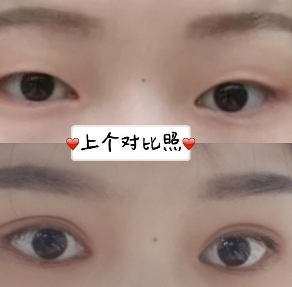 鞍山菲之都醫(yī)療整形醫(yī)院做開眼角+全切雙眼皮效果怎么樣？附藺嬌婷醫(yī)生案例