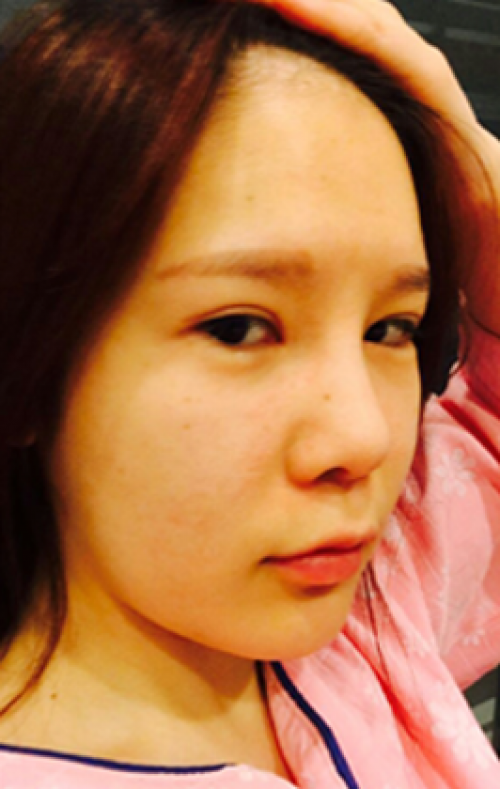 安康希顏醫(yī)療整形醫(yī)生王奇效做面部吸脂怎么樣？附案例效果對比圖