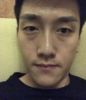 鞍山燕麗醫(yī)療美容醫(yī)院薛媚醫(yī)生做去眼袋效果怎么樣？附案例效果對比圖