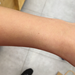 蚌埠市第三人民醫(yī)院燒傷整形科李勇醫(yī)生做手臂激光脫毛案例效果圖