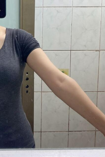 蚌埠市第三人民醫(yī)院燒傷整形科楊蔚做手臂吸脂效果對比圖 蚌埠市第三人民醫(yī)院燒傷整形科楊蔚做手臂吸脂效果對比圖