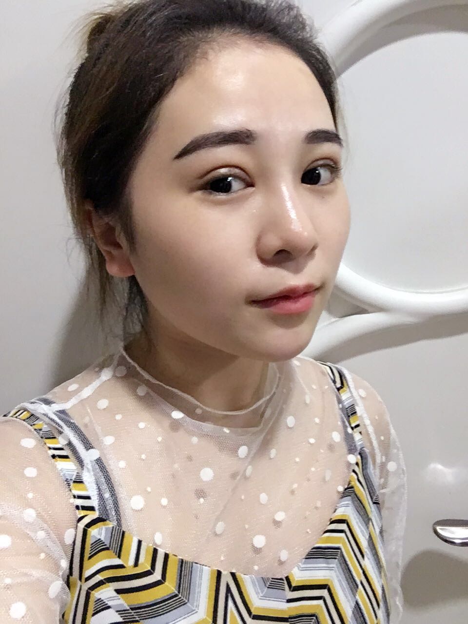 蚌埠韓美美萊整形醫(yī)生鄭捷做開眼角怎么樣？附案例效果圖