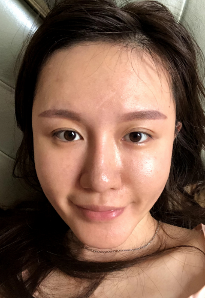 蚌埠韓美美萊整形醫(yī)生張燕做自體脂肪豐面頰效果怎么樣？附案例效果圖