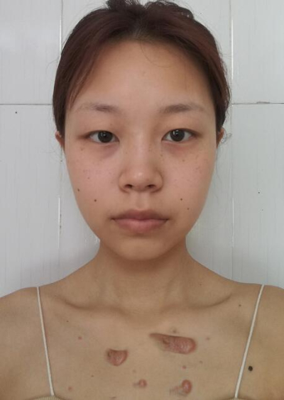 安陽市人民醫(yī)院燒傷整形中心做手術(shù)激光祛斑效果怎么樣？附案例效果對比圖