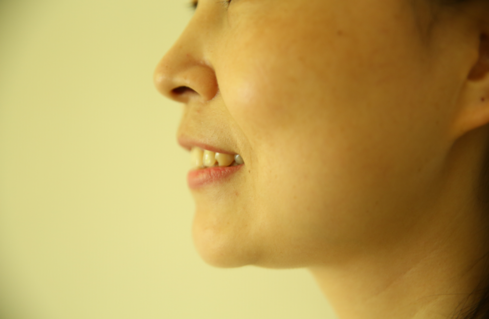 保定東陽口腔醫(yī)院趙星醫(yī)生做牙齒瓷貼面怎么樣?附牙齒瓷貼面案例效果對比圖